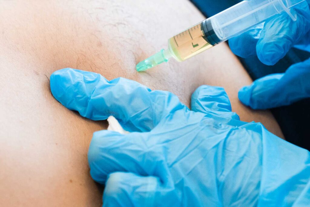 mesoterapia cos'è